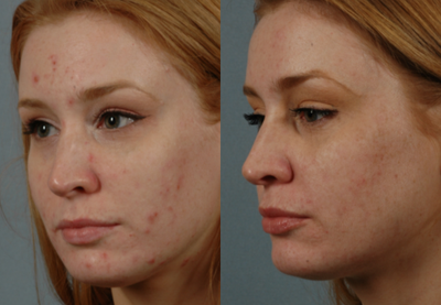 25-34 year old woman treated with Isolaz - 25-34 year old woman treated with Isolaz