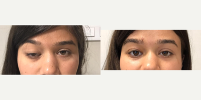 Woman treated with Ptosis Surgery - Revisional congenital ptosis surgery.