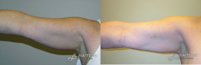 35-44 year old woman treated with Liposculpture - 35-44 year old woman treated with Liposculpture