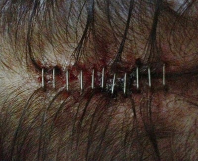 staples scalp mohs surgery care take ago