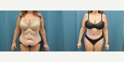 Woman treated with Tummy Tuck - Woman treated with Tummy Tuck
