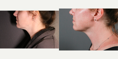 45-54 year old woman treated with Renuvion for Facial Resurfacing - Renuvion to the neck area,Renuvion for Facial Resurfacing, Liposuction, Vaser Liposuction andLaser Liposuction.
