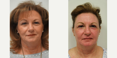 59 year old woman treated with Renuvion - 59-year-old female from Queen Creek, AZ. She visited our Gilbert office near Scottsdale, AZ. She was concerned with facial aging and wanted to restore a more youthful look as well as erase lines and wrinkles and restore volume to her face. Dr Olson decided full face J plasma with fat transfer and Halo Laser to the neck and chest would give this patient their desired outcome.Photos were taken only 6 weeks post procedure. The redness around her eyes will continue to fade with time.