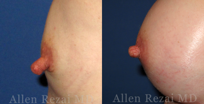 Nipple reduction surgery - Nipple Reduction SurgeryPhotos: Before & 4 Weeks After Surgery