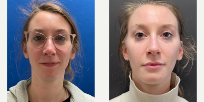 25-34 year old woman treated with Jaw Surgery - Double jaw surgery