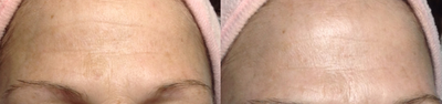 45-54 year old woman treated with Chemical Peel - 1 PCA Ultra Forte Peel