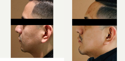 25-34 year old man treated with Chin Implant - Chin augmentation with silicone implant, combined with structural fat grafting to mid-face.