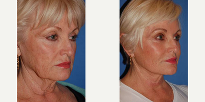 Woman treated with Cheek Implants - Woman treated with Cheek Implants