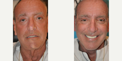 Man treated with SMAS Facelift - Man treated with Deep Plane Facelift, SMAS Facelift, and the subcuticular plane. Eyelid Surgery was also performed. Patient is shown before and 2 weeks post-op.