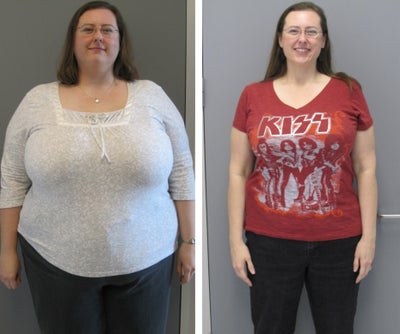 Before & After - 
	12 months post-op
