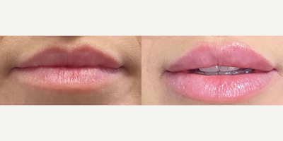 Woman treated with Lip Fillers - Woman treated with Lip Fillers