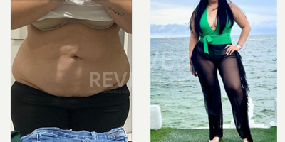 Body Transformation - Liposuction & Breast Lift - The patient carried excess weight around her abdomen, flanks, and back. She was a great candidate for liposuction 360, and the result is just what she was looking for!
