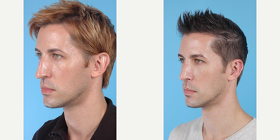 34 year old man treated with Rhinoplasty - A 34 year-old Gentleman before and after Rhinoplasty and Correction of Prominent Ears ( Otoplasty) by Andrew Lyos M.D FACS.