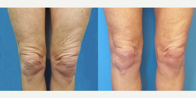 57 year old woman treated with Thermage - This patient wanted to tighten up lax skin on her knees.
