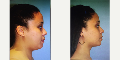 18-24 year old woman treated with Chin Liposuction - My version of chin liposuction The Angle. Surgical time 25 min, under twilight anesthesia and local. No pain results are immediate. Recovery time 4 days.