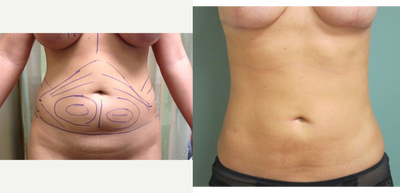 25-34 year old woman treated with Smart Lipo - Liposuction of Abdomen, Flanks, and Love Handles