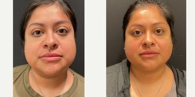 25-34 year old woman treated with Renuvion - Buccal fat pad removal with submental chin liposuction and Renuvion.