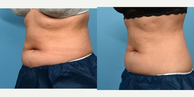 25-34 year old woman treated with Cryolipolysis - This 25-year-old patient was treated with one session of CoolSculpting for the abdomen. Six months post-procedure, she's thrilled with the amount of fat reduction in her mid-section and how much better her clothes fit.
