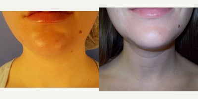 18-24 year old woman treated with AccuTite - Accutite chin and jowls