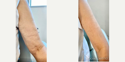 55-64 year old woman treated with Skin Rejuvenation - Skin rejuvenation by Dr. Arash Moradzadeh