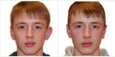 Young man treated with Ear Surgery - 15-25 yo male c/o left ear protruding. He was born without an antihelical fold in the left ear causing it to protrude further then the right ear. He underwent a left ear otoplasty under local anesthesia to recreate the antihelical fold.