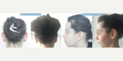 22 year old woman treated with Ear Surgery - Dr. Orge Ergun&nbsp;performed ear Pinning surgery to young female patient, and this is the result of 21 days later after the surgery.