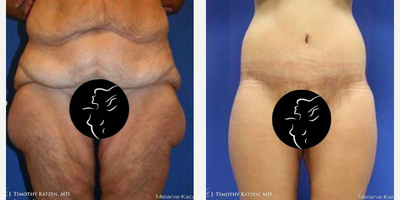 25-34 year old woman treated with Body Lift - This female patient in their mid-40s was not happy with the excess skin and fat in their outer thighs/hips. So, the patient underwent a wedge saddlebag removal. A wedge saddlebag removal procedure includes the use of general anesthesia and takes about 3-4 hours to complete. The wedge technique is a surgical procedure that removes excess skin and fat over the saddlebag region. During the wedge procedure, an elliptical or football-shaped area of excess skin and fat is removed from the lateral hip or trochanteric region.