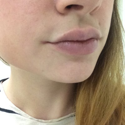 Can fillers be used to treat angular cheilitis? Even if you're not ...