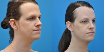25-34 year old transgender woman treated with Brow Bone Reduction, Brow Lift, Rhinoplasty, Genioplasty, Transgender Facial Femin - Patient is a transgender female that underwent FFS with forehead reduction, browbone reduction with sinus setback and orbital rim contouring, browlift, rhinoplasty, and shave genioplasty.