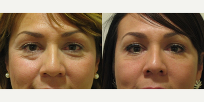 Woman treated with Restylane, Botox, Mesotherapy - Woman treated with Restylane, Botox, Mesotherapy