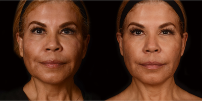 Non Surgical Face Lift - This is a woman in her 50's who had Instalift threading for a non-invasive mid-face lift. She is 3 months post-op. ( Non Surgical Facelift)