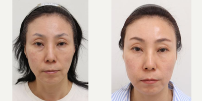 45-54 year old woman treated with Silhouette Soft, AccuLift, Nonsurgical Facelift - 52 Years old female patient Chief Complains: sagging cheeks, under eye bags, uneven face line Treatment plan: - perioral mounds liposuction- silhouette soft thread lift (for middle face area)- full face fat graft- eyelid nano-fat graft- transconjunctival fat repositioning T/C Effect : - smooth face line (temple & cheek hollows was fixed) - face volume restore (forehead, upper cheeks) > more youthful look - flat and smooth eye area- slight lifting effect (lower and middle face part)