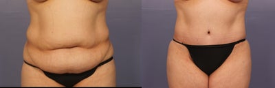 No Drain Tummy Tuck - Mid 30s female, underwent No-drain Tummy tuck and liposuction of her abdomen, love handles and lower back area.