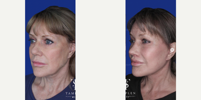 Woman treated with Brow Lift, Deep Plane Facelift, Lip Lift, Rhinoplasty - This lovely patient had a previous facelift but was bothered by persistent jowls and neckbands.She was also unhappy with the appearance of her nose and the scarring from her previous facelift.She now absolutely loves her new look which was achieved through 1 single transformative procedure that included my extended deep plane facelift, lateral brow lift, lip lift, and open rhinoplasty.Looking refreshed, elegant, and natural. Loving these results!