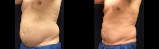 coolsculpting before and after result