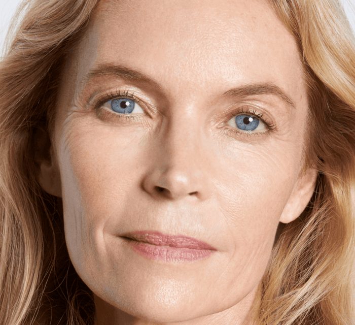 Facelift