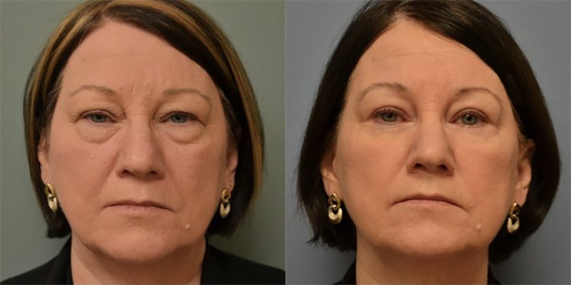 Eyelid Surgery: Frequently Asked Questions - RealSelf