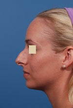 melanotan 2 reviews Melanotan 2/ Good Effects/ Bad Effects