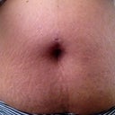 Laser Liposuction 2014