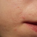 Best Treatment For Pitted Scarring Due To Ingrown Hairs Photo