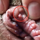 Bump on clitoris pic 179