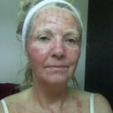Smartskin Co2 Laser Skin Resurfacing Realself