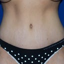 53 Stretch Marks Treatment Doctors Clinics In Charlotte Nc Realself