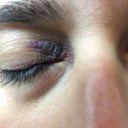 Unexplained bruise under eye deals