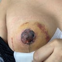 TW GORE) My nipple necrosis journey so far- almost 6 weeks post op :  r/Top_Surgery_Peri