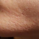 Best Treatment For Pitted Scarring Due To Ingrown Hairs Photo