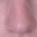 Do I Have An Open Roof Deformity Or An Inverted V Deformity Photos