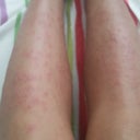 Why Do I Have White Itchy Bumps After My First Diode Laser Hair