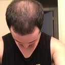 Hair Transplant For Diffuse Thinning On The Top Of My Scalp 27 28