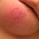 What could cause sudden red, itchy bruise looking spot on breast